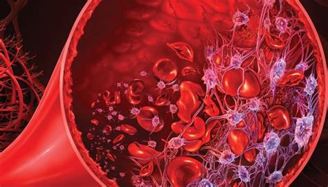 atypical hemolytic uremic syndrome ahus  symptoms