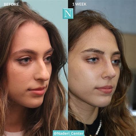 Rhinoplasty By The Noseman Using Structural And Preservation Techniques