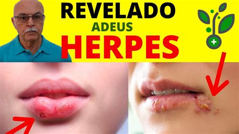 Tem Como Pegar Herpes Sozinho BRAINCP