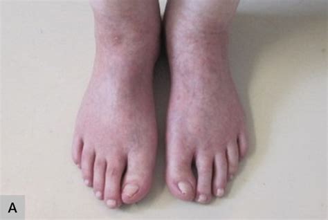 Zinc Deficiency Acrodermatitis Enteropathica