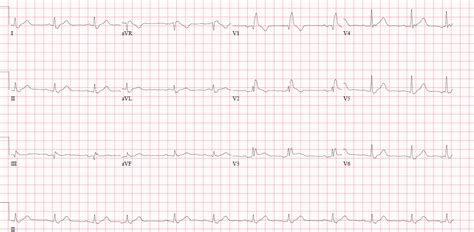 St Elevation Mi Stemi Cardio Guide