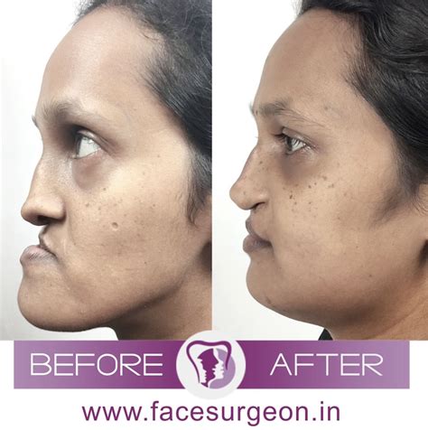 Concave And Long Face Corrected By Jaw Surgery Facial Surgery Lip