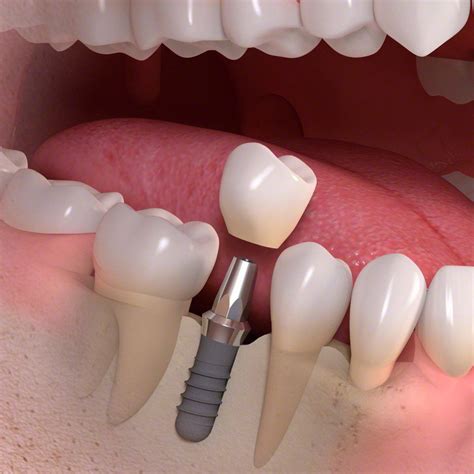 Dental Implant Vs Dental Bridge