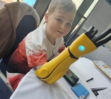 Good Samaritan Buys Football Mad Disabled Boy A New Bionic Arm