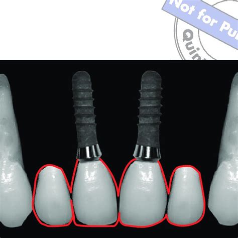 Pdf Replacing Four Missing Maxillary Incisors With Regular Or Narrow