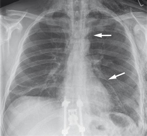 Mediastinum Radiology Key