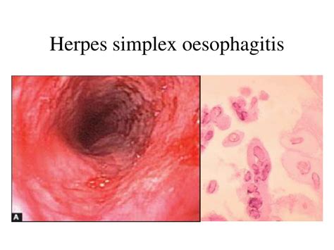 Ppt Pathogenesis Of Diseases Of The Oesophagus Powerpoint