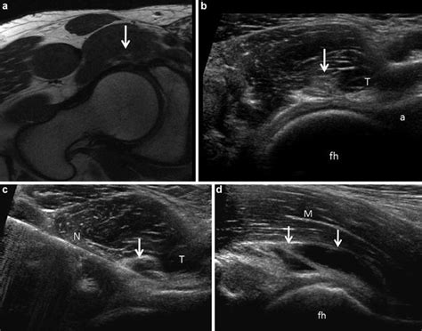 Ultrasound Of The Hip Musculoskeletal Key