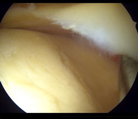 Schatzker Iii Arthroscopically Assisted Joint Surface Reduction