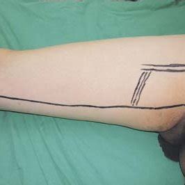 Three months after the gracilis muscle flap transposition showing... | Download Scientific Diagram