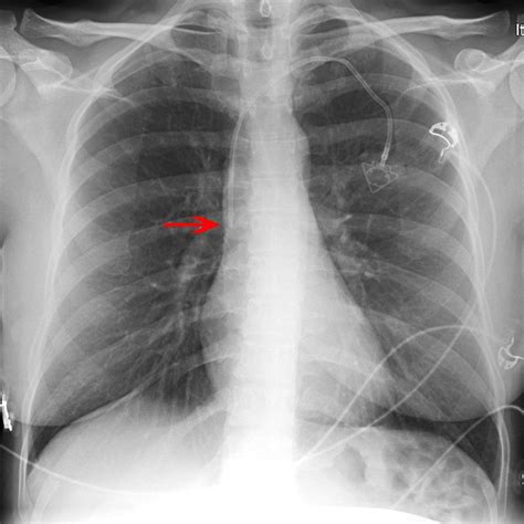 How To Do Internal Jugular Vein Cannulation Critical Care Medicine