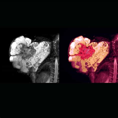 Soft tissue sarcoma - Vejthani Hospital | JCI Accredited International ...