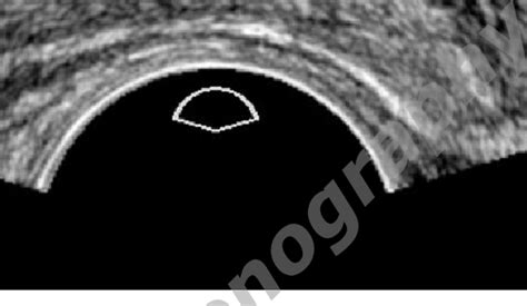 B B Transrectal Us Shows That Right Arrow And Left Arrows Cancers Download Scientific