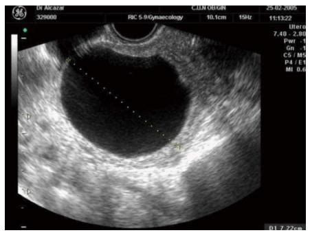 Serous Ovarian Cancer Ultrasound - CancerWalls