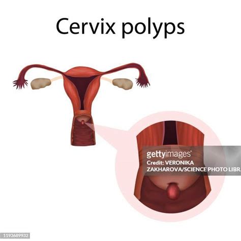 18 Cervical Polyps Stock Photos, High-Res Pictures, and Images - Getty ...