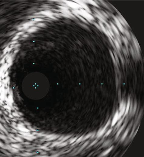 (a and b) Coronary CT angiography demonstrating proximal left ...