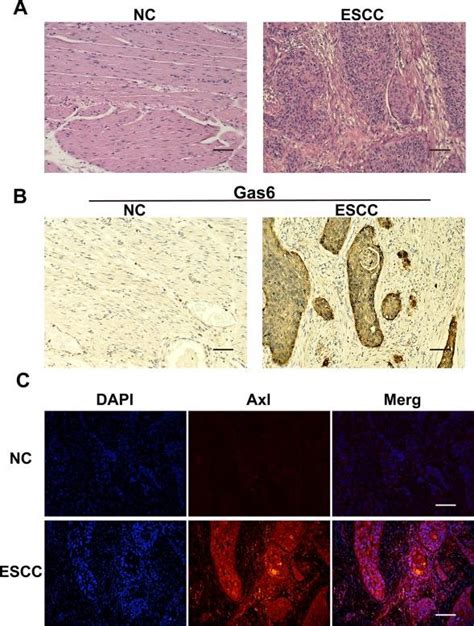 Gas6 And Axl Expression In ESCC Tissues A HE Staining NC Nontumor