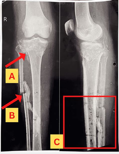 X-ray showing the anteroposterior view (left) and lateral view (right)... | Download Scientific ...