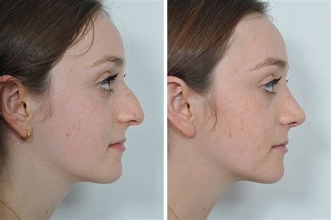 Rhinoplasty Nose Surgery Nose Job For Women In New York City David