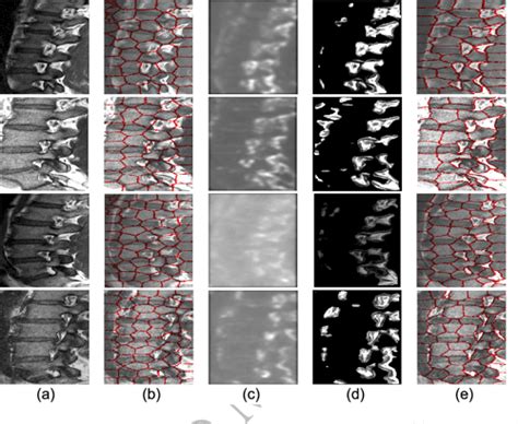 Figure 1 From Automated Neural Foraminal Stenosis Grading Via Task