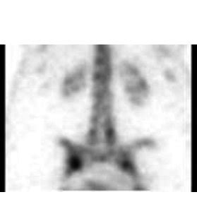 Technetium-99m-MDP SPECT in Ankylosing Spondylitis. Technetium-99m-M DP ...