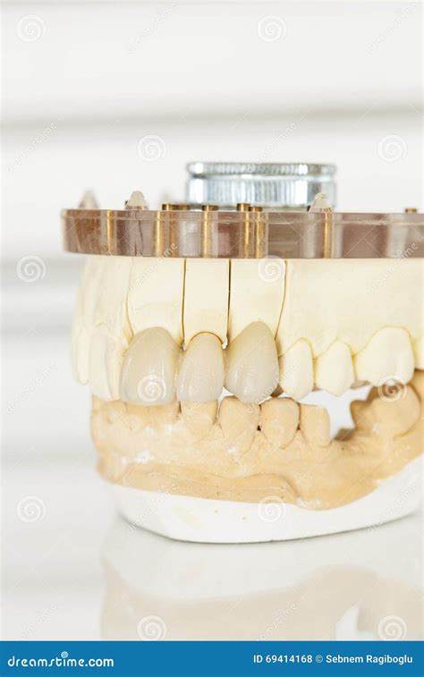 Metal Free Ceramic Dental Crowns Stock Photo Image Of Molar Crown