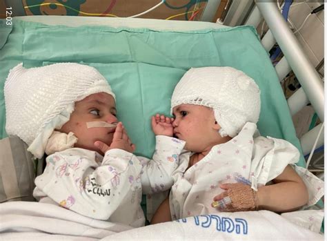 Born Conjoined Back To Back Israeli Twins Finally See Each Other After Surgery Reuters