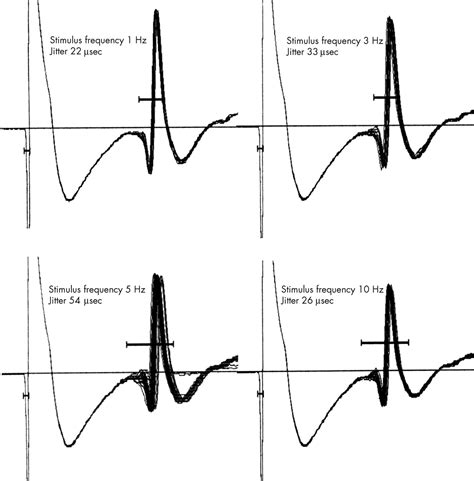 Specialised Electromyography And Nerve Conduction Studies Journal Of