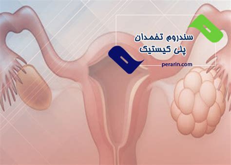 سندروم تخمدان پلی کیستیک پرارین پارس