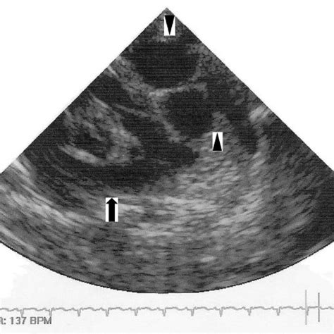 Differential Diagnosis Of Cystic Mediastinal Chest Masses Download Table