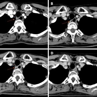 Computed Tomography Findings Showing Level Of Left Bronchus A Initial