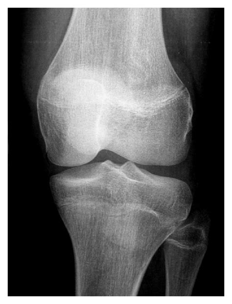 Radiograph Of The Patient S Left Knee In Anteroposterior A And