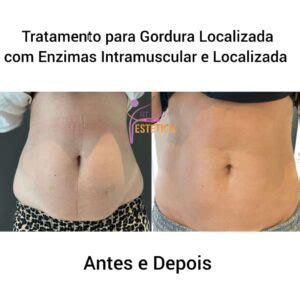 Tratamento Para Gordura Localizada E Emagrecimento Cl Nica Fit Body