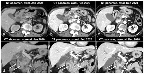 A Case with Multiple Pathologies in the Pancreatic Head