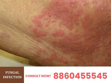 Fungal Infection — Symptom, Causes & Treatment in Deoria | by Dr ...