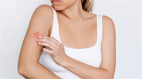 The Most Effective Ways To Get Rid Of Hives