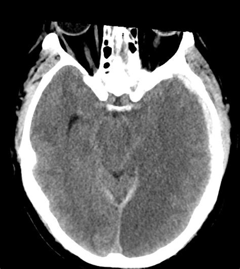 Inferior Sagittal Sinus Mri