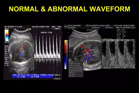 Color Doppler In Fetal Hypoxia PPT