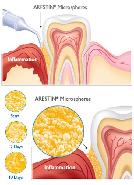 Premier Dental Care - ARESTIN Periodontal Antibiotic Therapy