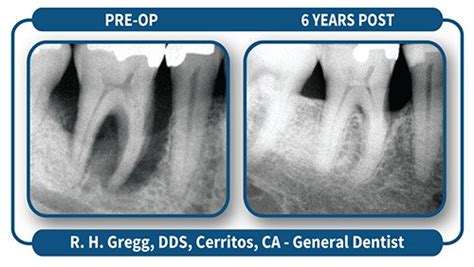 Lanap Laser Surgery Montclair Cunning Dental Group