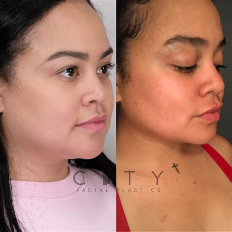 NYC Buccal Fat Removal Before and After Pictures | New York | UES