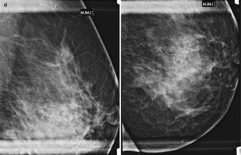 Invasive Ductal Carcinoma Mammogram