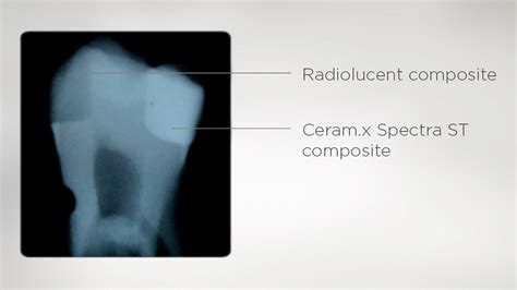 Ceram X Spectra St Dentsply Sirona Sweden