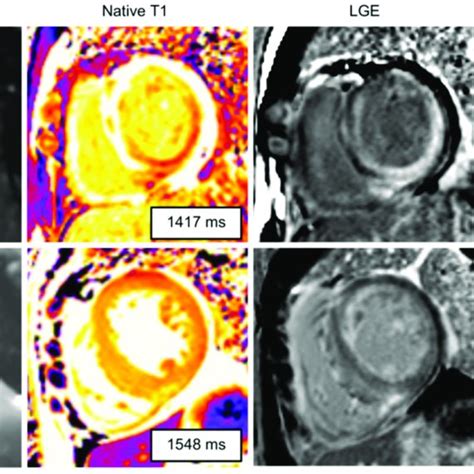 Cardiac Magnetic Resonance Cmr Findings Of Cardiac Amyloidosis