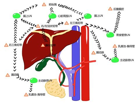 3 张手绘图，教你读懂肝脏淋巴回流患者