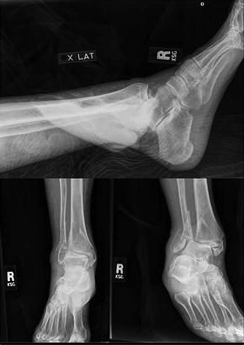 Aplastic Posterior Tibial Artery In The Presence Of Trimalleolar Ankle