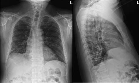 Chest X‐ray in June 2021: Improved aeration of the lungs with ...