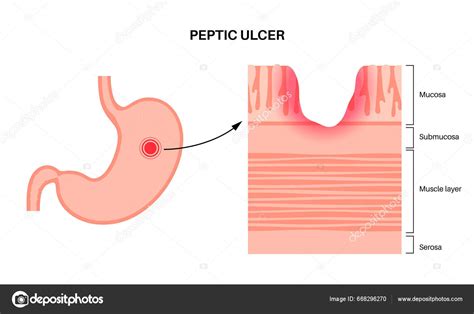 Enfermedad Lcera P Ptica Dolor Pared Del Est Mago Dolor Abdominal