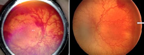 Retinopathy Of Prematurity Plus Disease