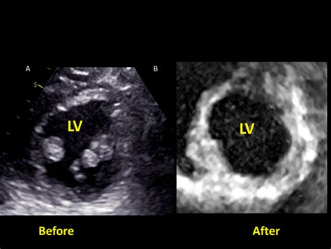 The Left Ventricular Short Axis Views Before A And After B Valve